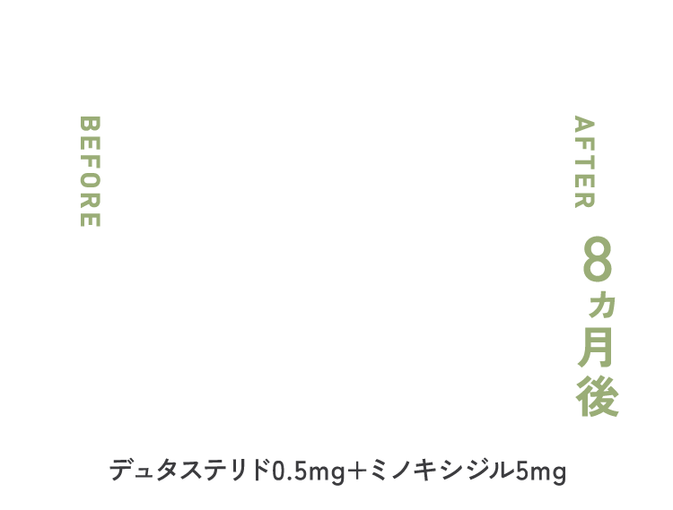 デュタステリド 0.5mg × ミノキシジル 5mg 8ヶ月後