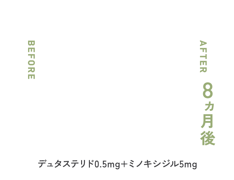 デュタステリド 0.5mg × ミノキシジル 5mg 8ヶ月後