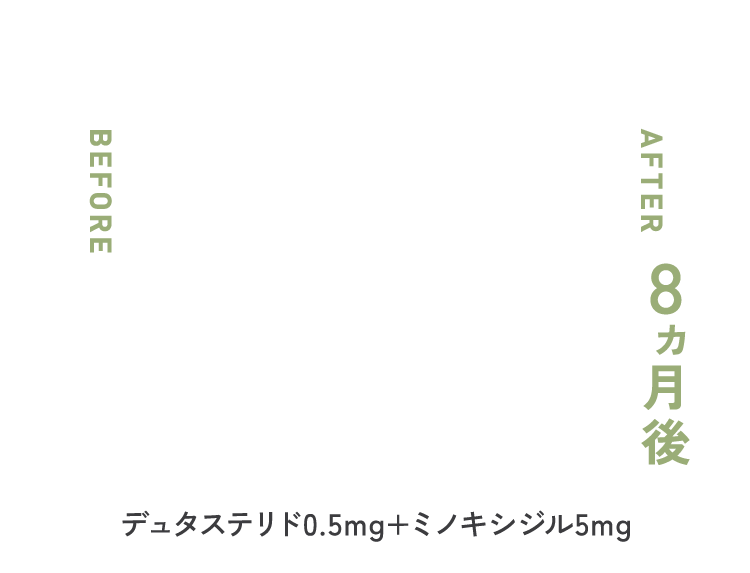 デュタステリド 0.5mg × ミノキシジル 5mg 8ヶ月後
