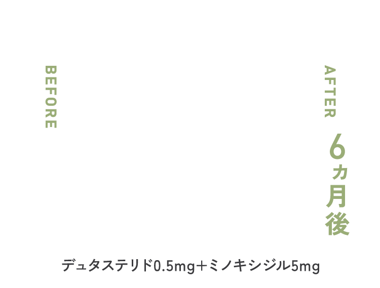 デュタステリド 0.5mg × ミノキシジル 5mg ６ヶ月後