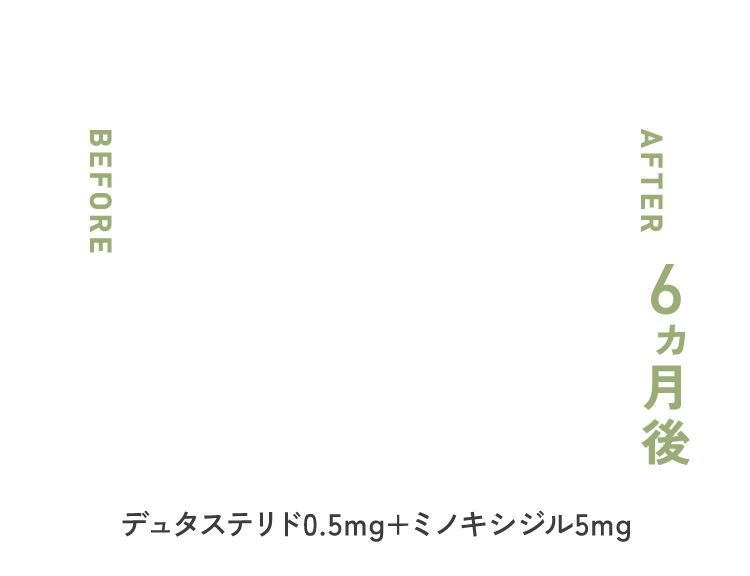 デュタステリド 0.5mg × ミノキシジル 5mg ６ヶ月後