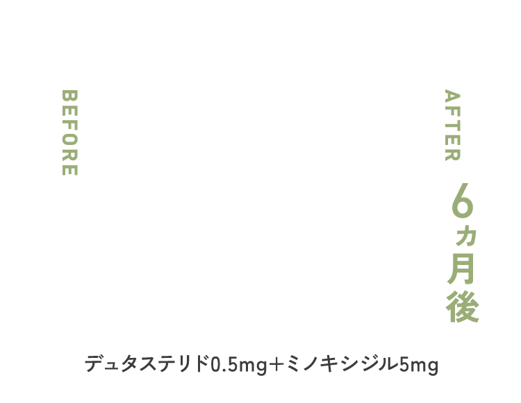 デュタステリド 0.5mg × ミノキシジル 5mg ６ヶ月後