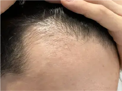 生え際