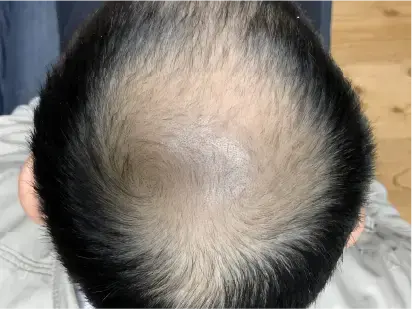 頭頂部