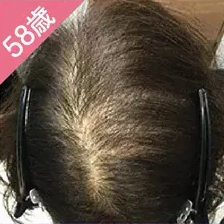 ヘアクリ 症例1 Before