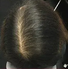 ヘアクリ 症例1 After