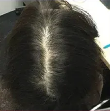 ヘアクリ 症例2 After