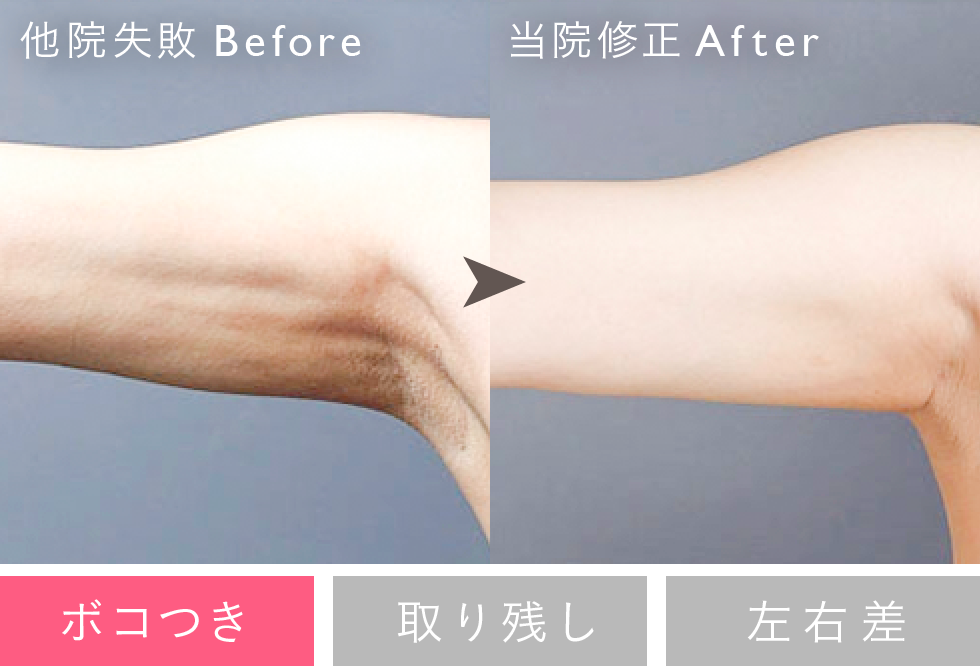 失敗修正例：ボコつき Before/After