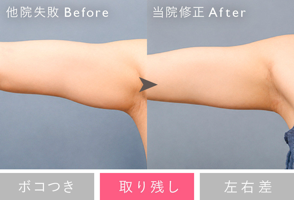 失敗修正例：取り残し Before/After
