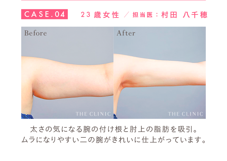 CASE.04 23歳女性 担当医：村田 八千穂 Before/After