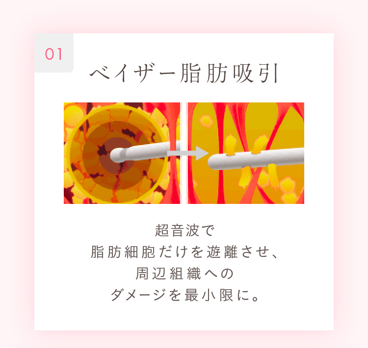 01 ベイザー脂肪吸引 超音波で脂肪細胞だけを遊離させ、周辺組織へのダメージを最小限に。