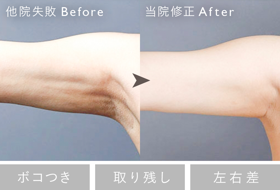 失敗修正例：ボコつき Before/After