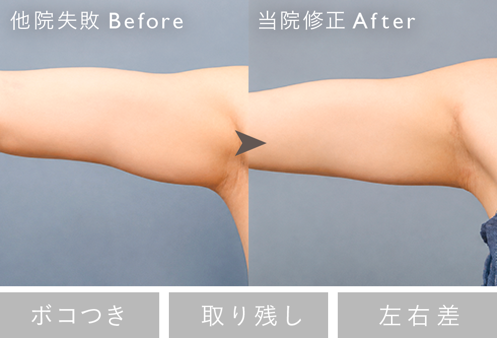 失敗修正例：取り残し Before/After