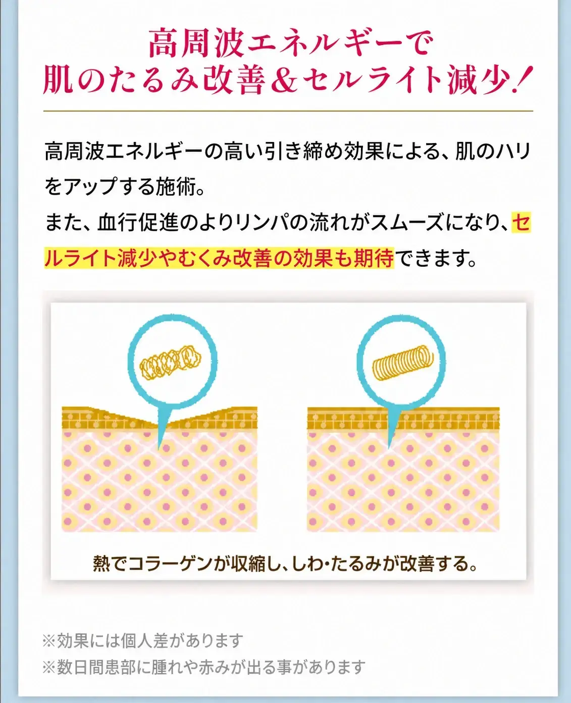 医療ラジオ波＜顔・ボディ＞
